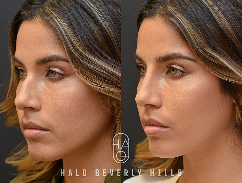 Non-Surgical Rhinoplasty before and after