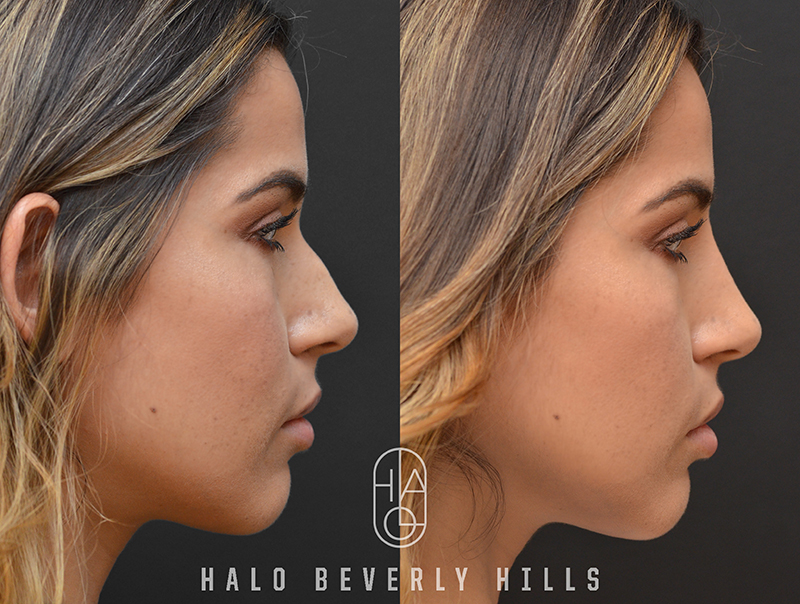Non-Surgical Rhinoplasty before and after