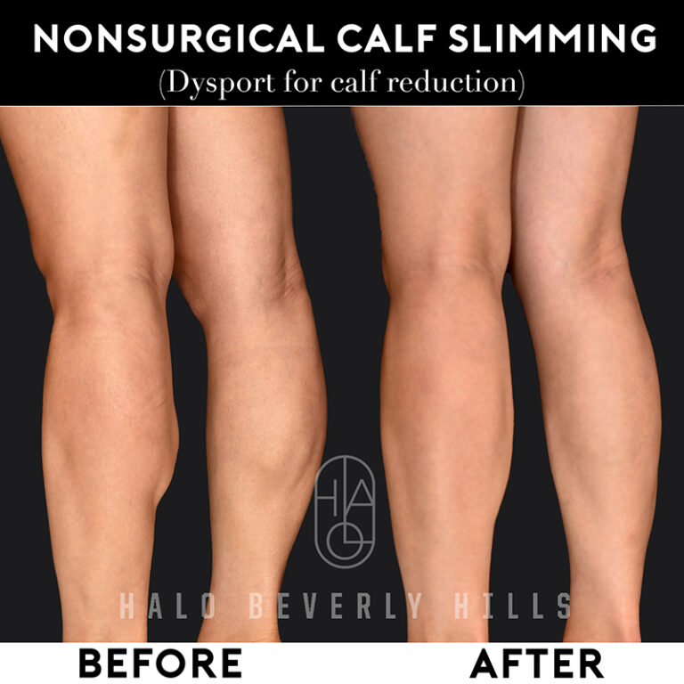 Calf Slimming Before and After