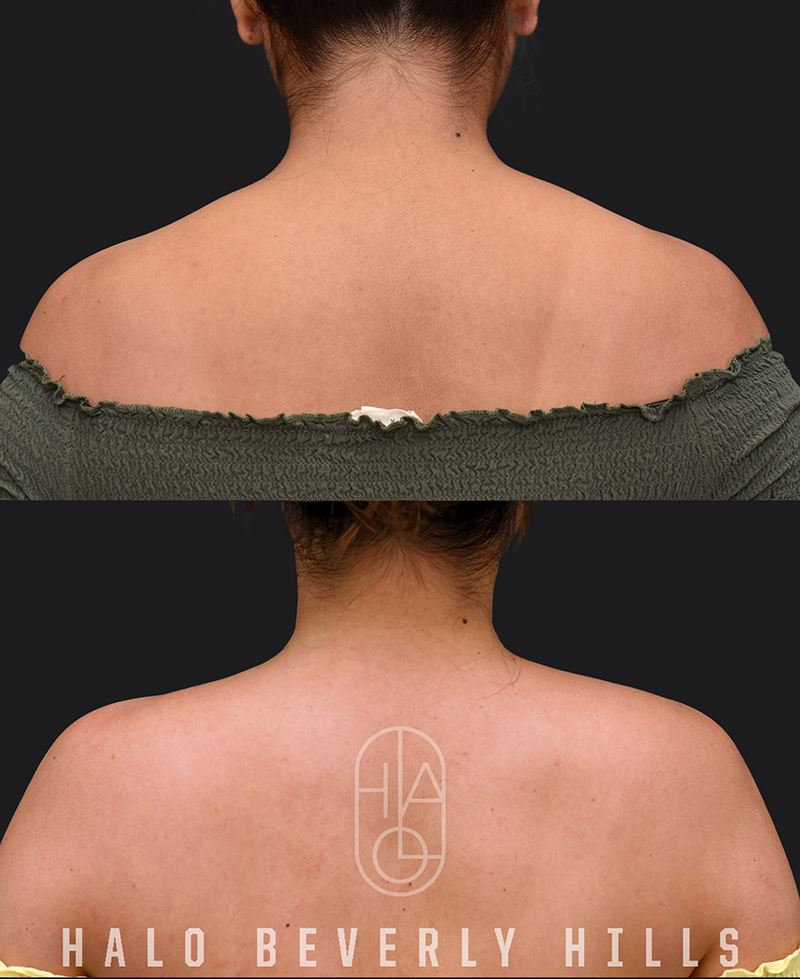 Trapezius Slimming / Barbietox Before and After