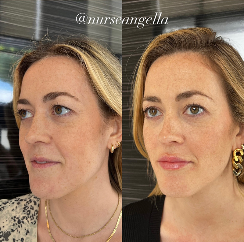 lip augmentation before and after