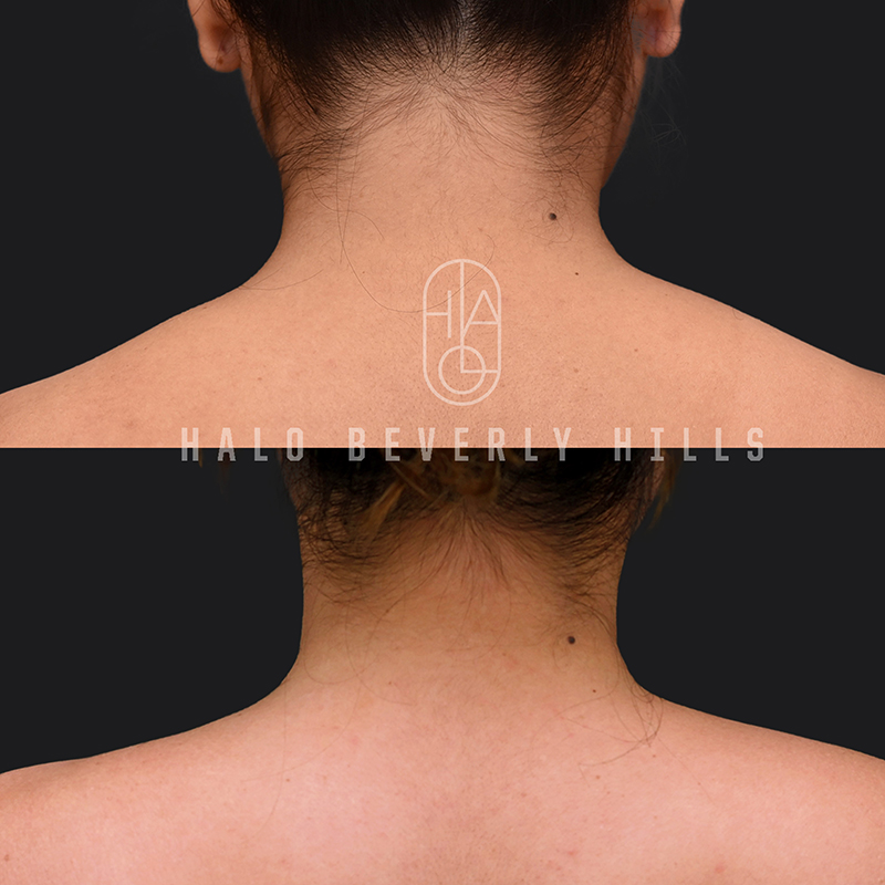 Trapezius Slimming / Barbietox Before and After