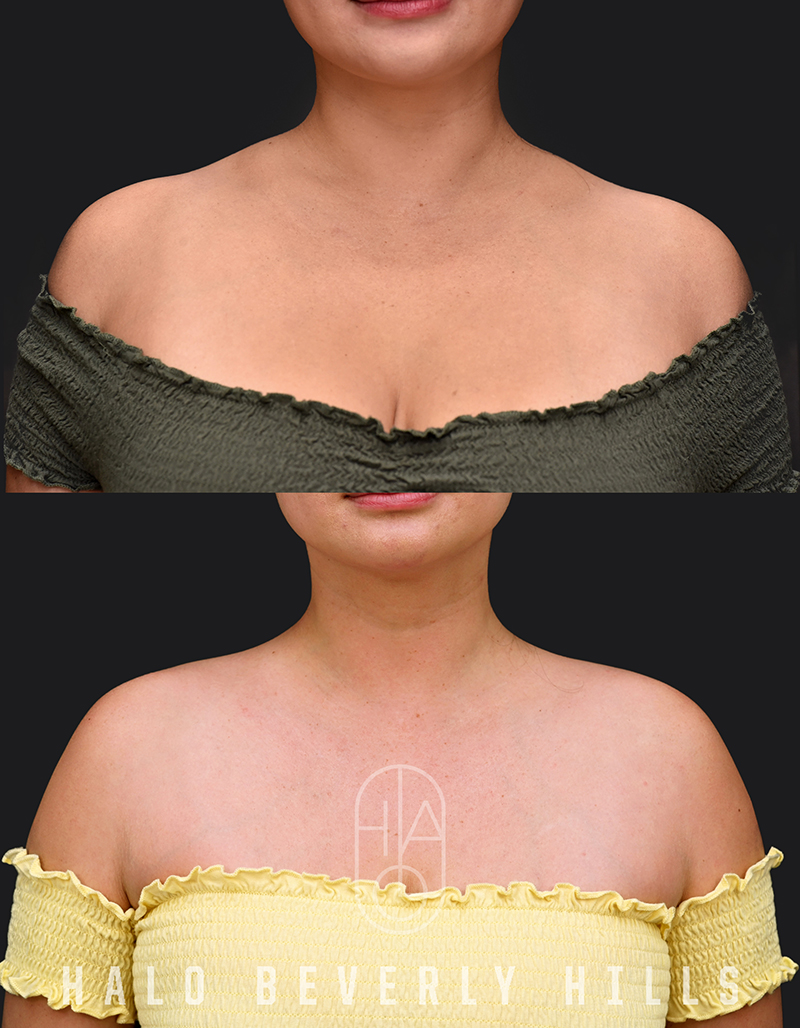 Trapezius Slimming / Barbietox Before and After