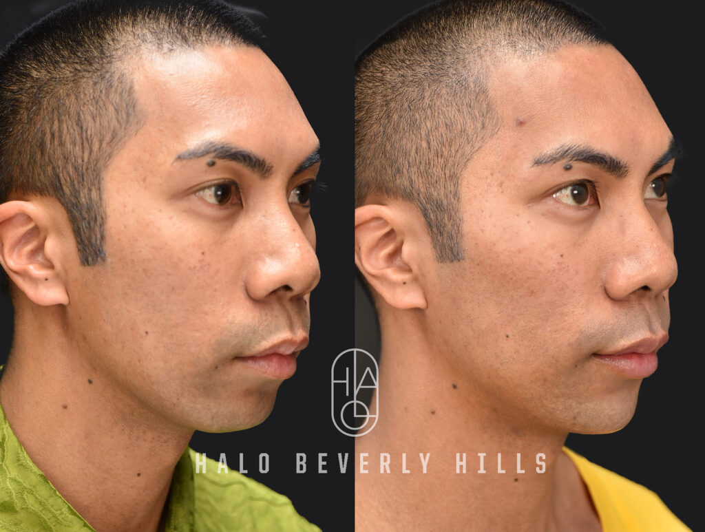 Dermal Filler Before and After