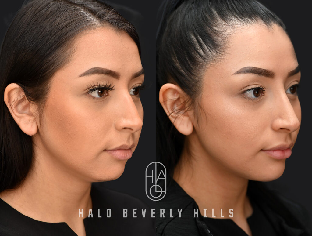 Dermal Filler Before and After 1