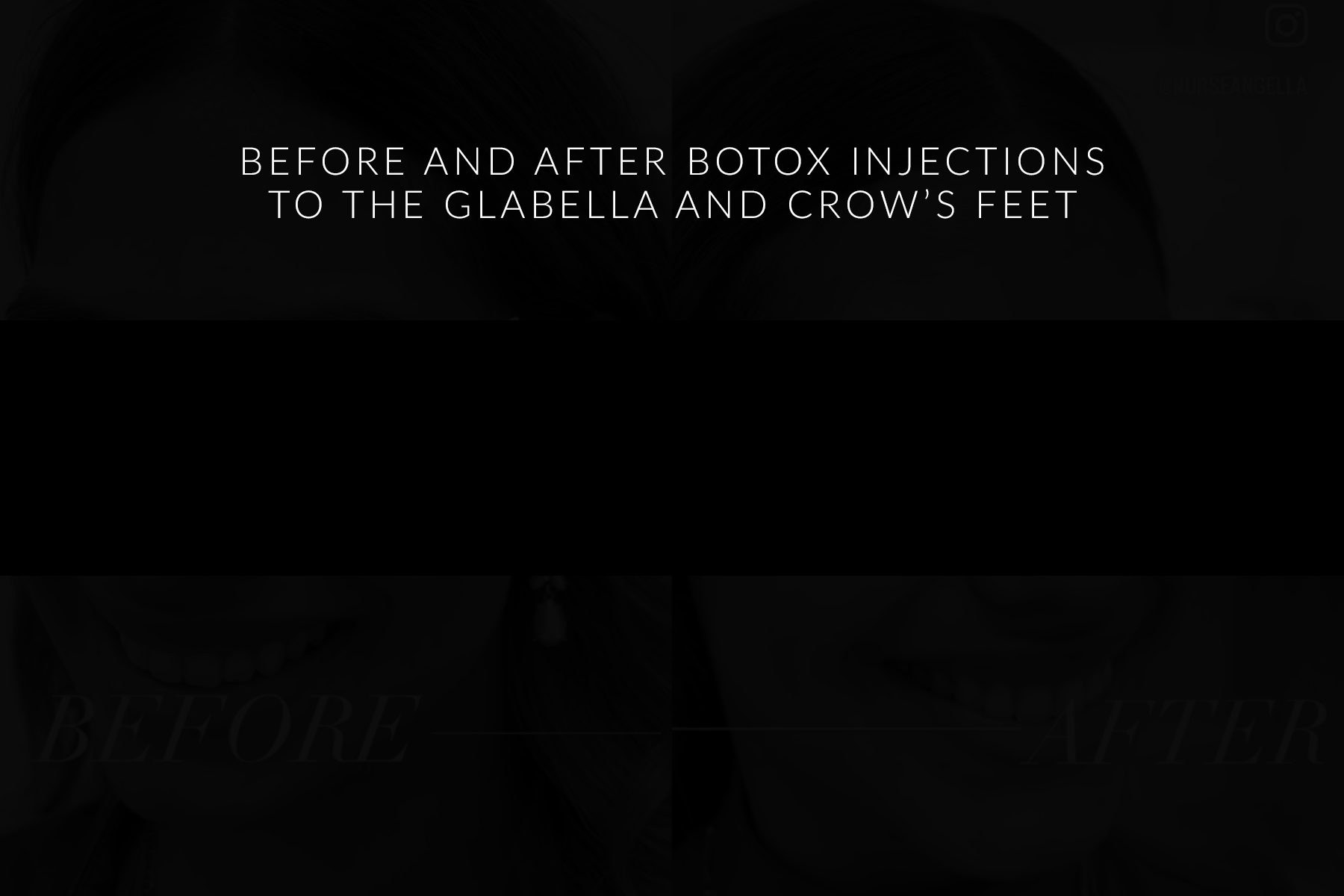 before and after botox injection video