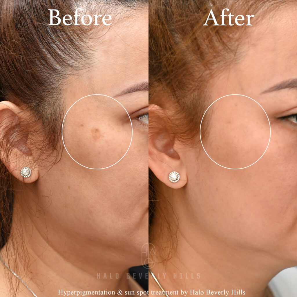Vl Picosure Right 3qt View Circle