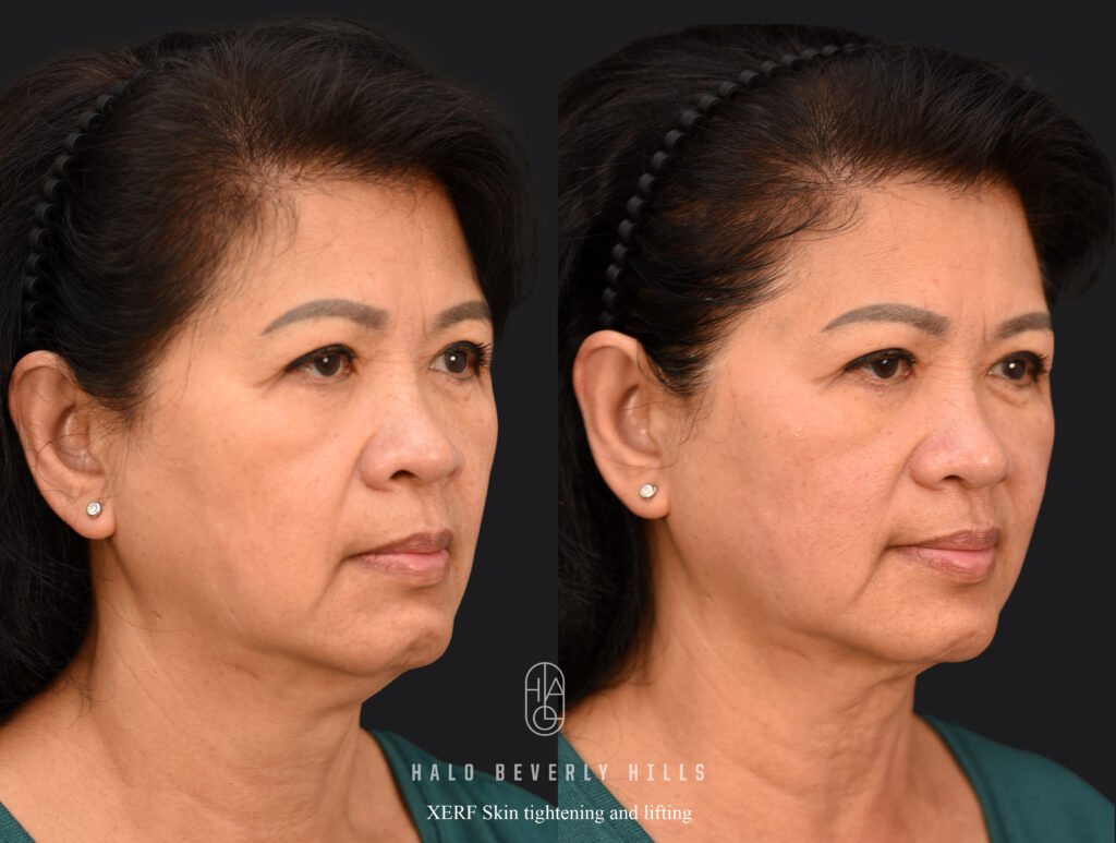 XERF skin tightening before and after at HALO Beverly Hills (full face and neck)