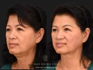XERF skin tightening before and after at HALO Beverly Hills (full face and neck)