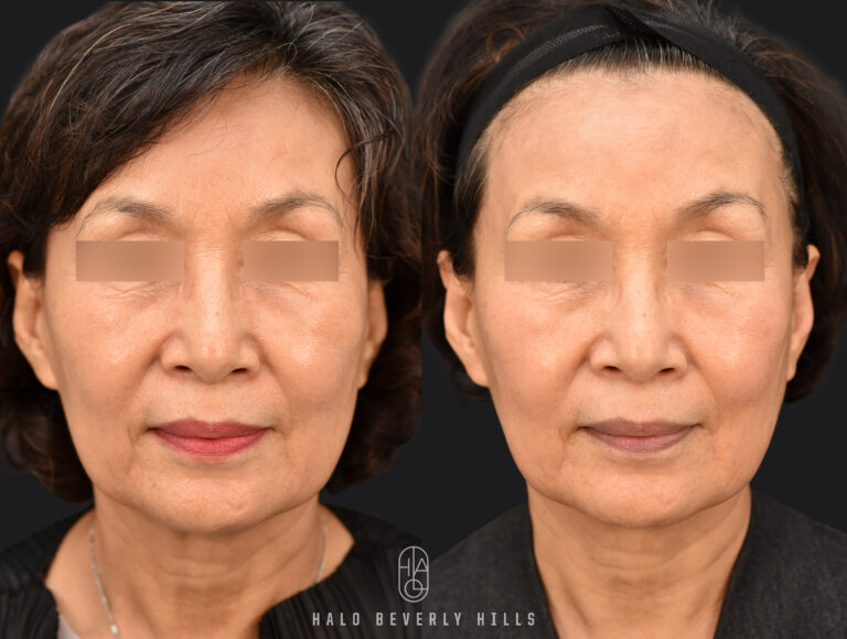 Ultherapy Prime before and after