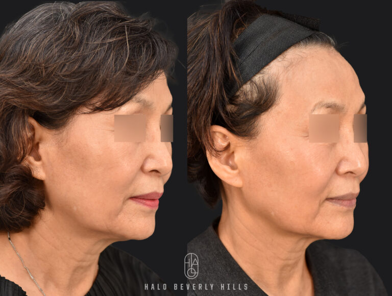 Ultherapy Prime before and after