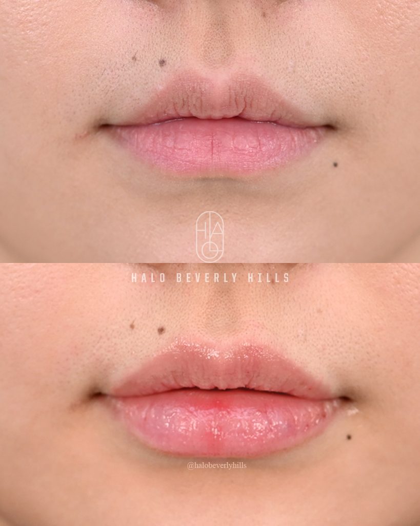 Wm Lip Filler Frontal Close View Copy
