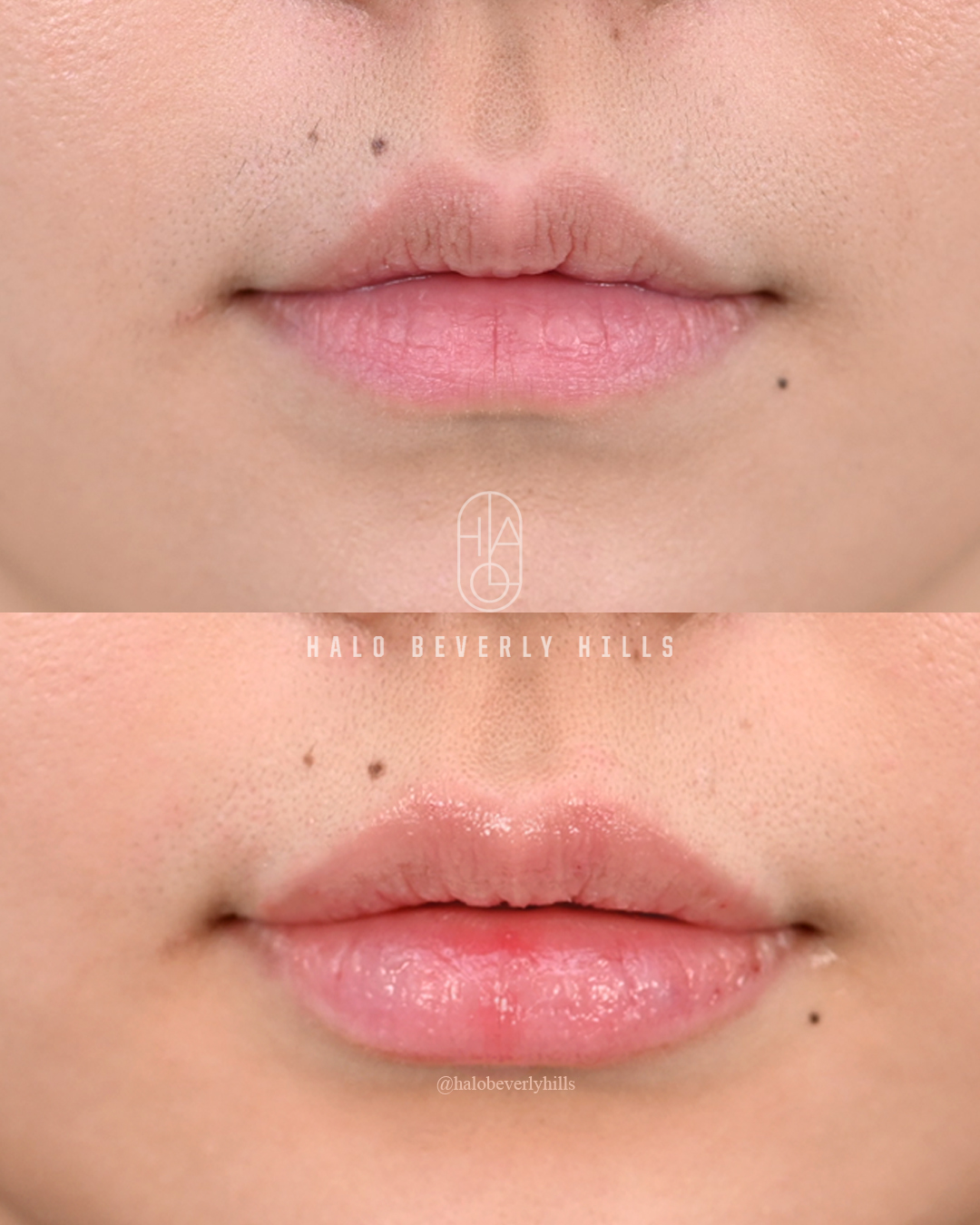 Wm Lip Filler Frontal Close View Copy