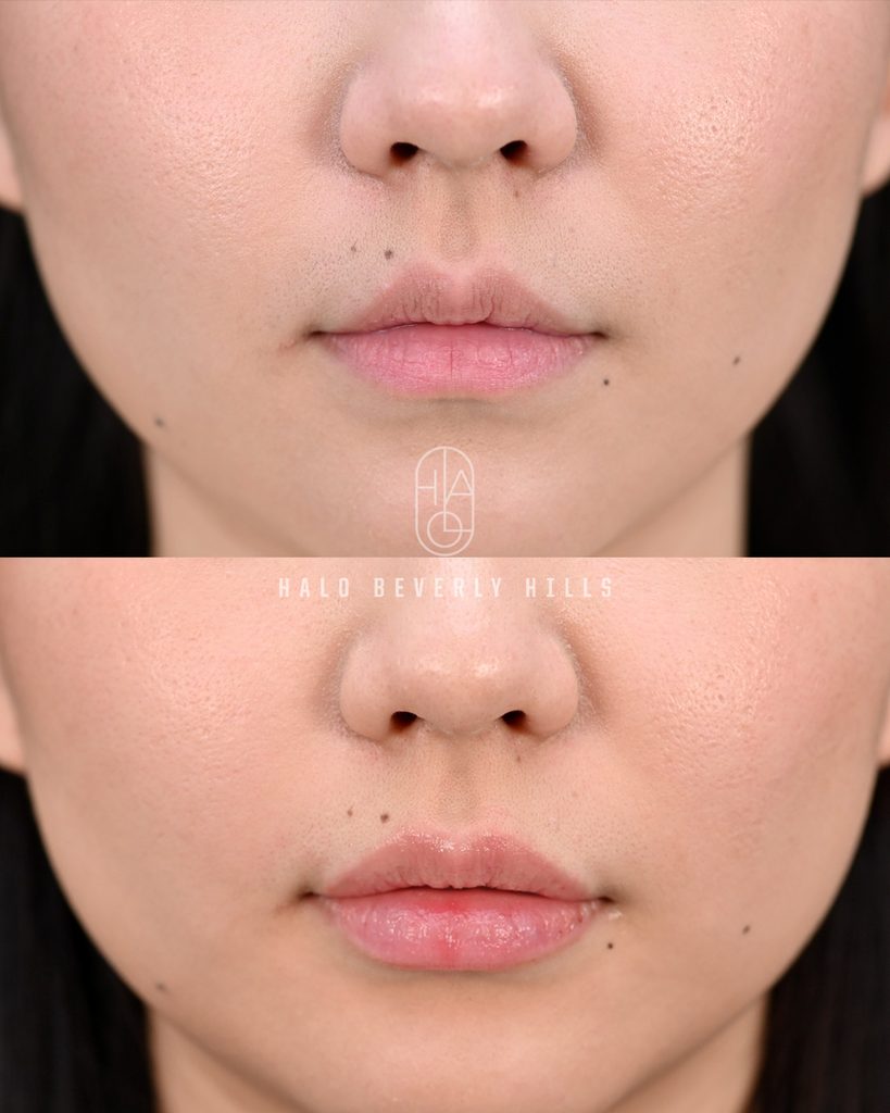 Wm Lip Filler Frontal View Copy