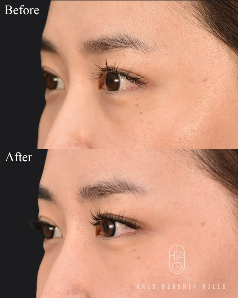 A customized under-eye rejuvenation treatment designed to improve hollowness, volume loss, and overall under-eye contour for a smoother, brighter, more refreshed appearance. ✨