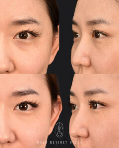 A customized under-eye rejuvenation treatment designed to improve hollowness, volume loss, and overall under-eye contour for a smoother, brighter, more refreshed appearance. ✨