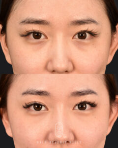 A customized under-eye rejuvenation treatment designed to improve hollowness, volume loss, and overall under-eye contour for a smoother, brighter, more refreshed appearance. ✨